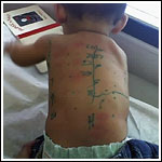 Allergy