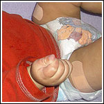 Bandaged